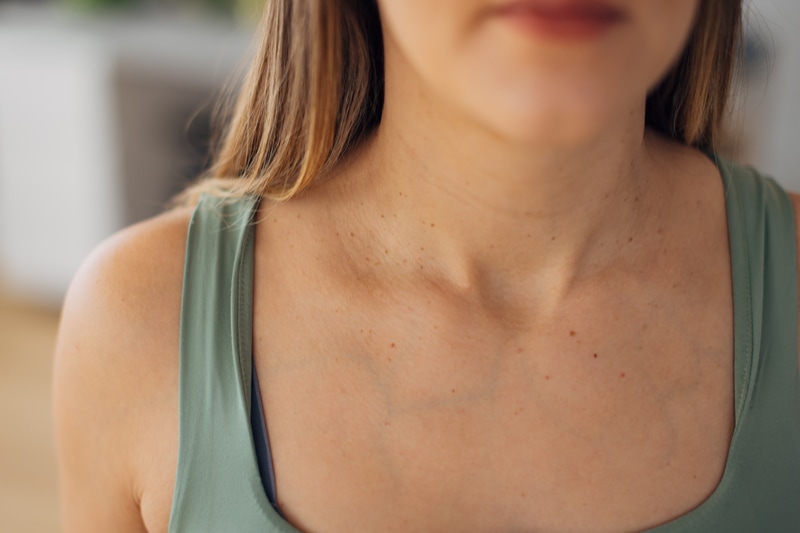 Pigment Memory: Why Sunspots Return After IPL