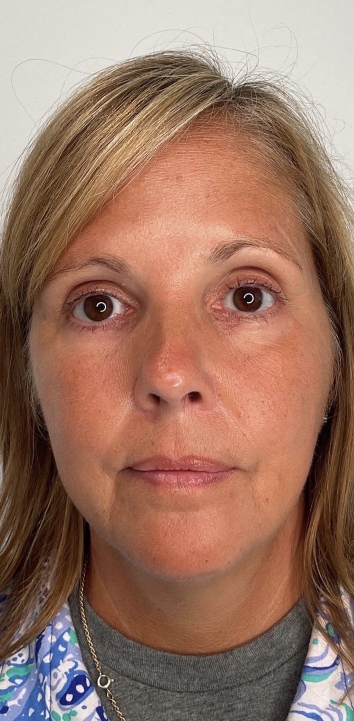 Botox Before & After Image