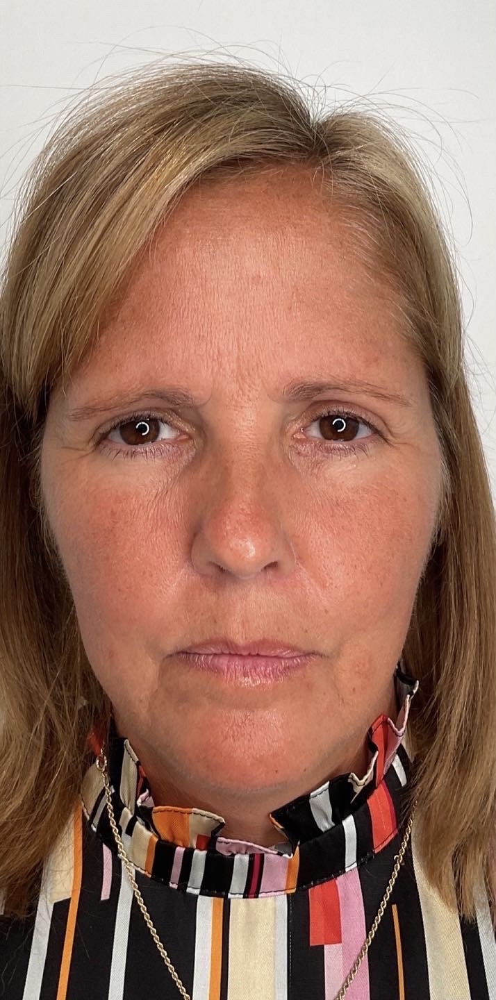 Botox Before & After Image