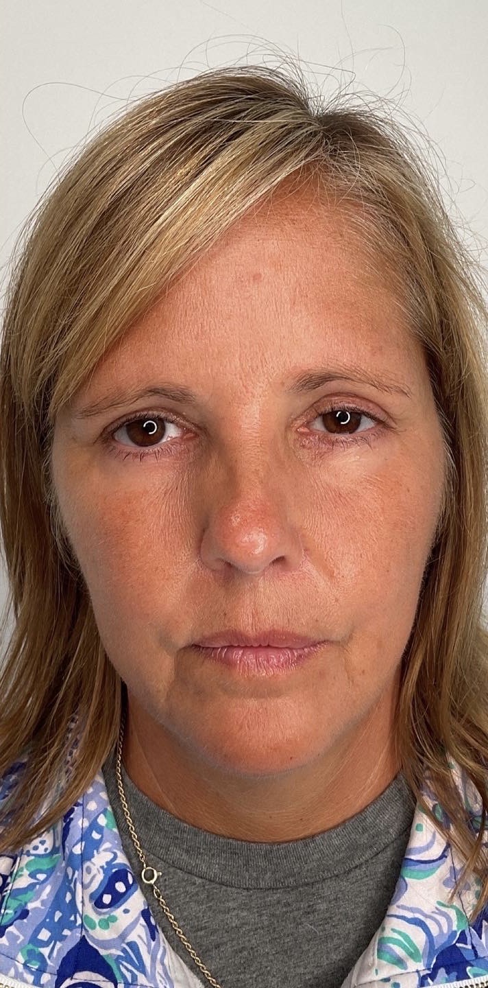 Botox Before & After Image