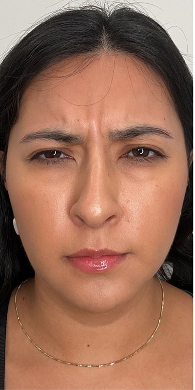 Botox Before & After Image