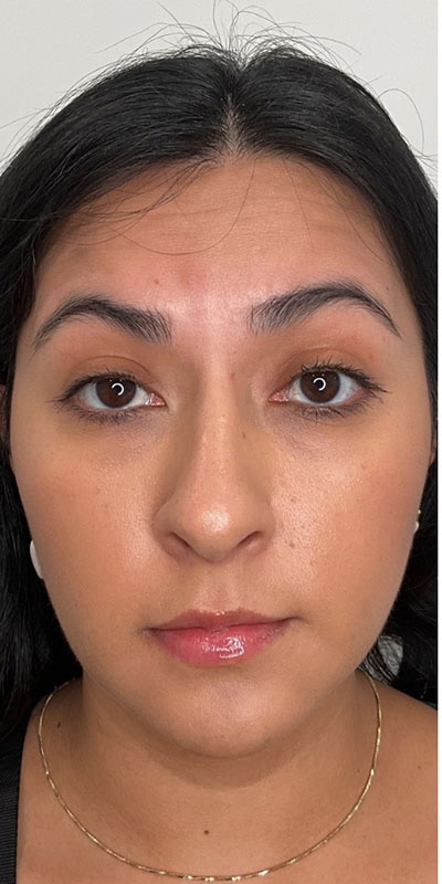 Botox Before & After Image