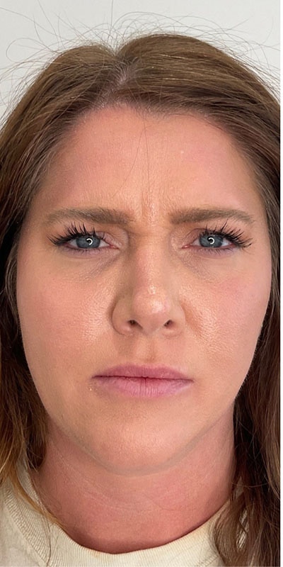 Botox Before & After Image