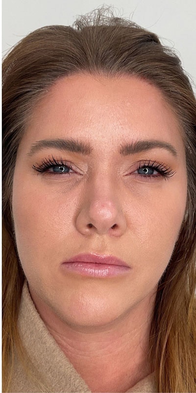 Botox Before & After Image