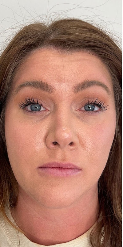 Botox Before & After Image