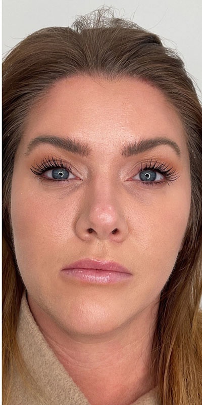 Botox Before & After Image