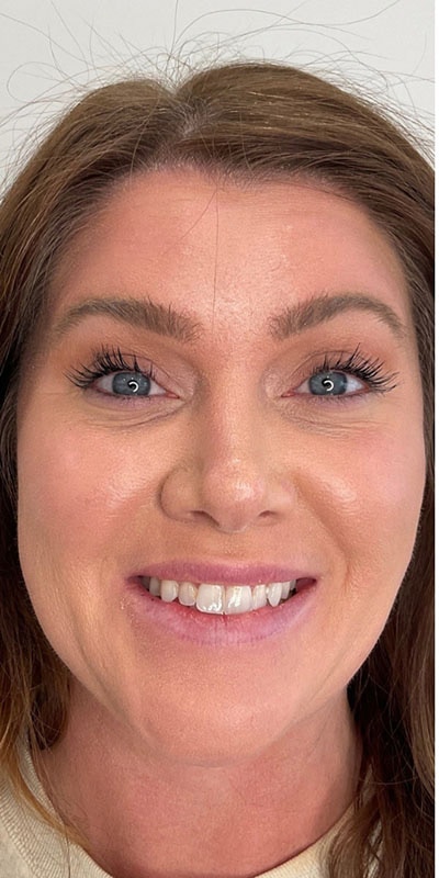 Botox Before & After Image