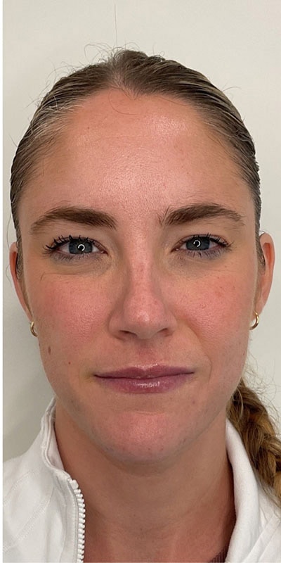 Botox Before & After Image