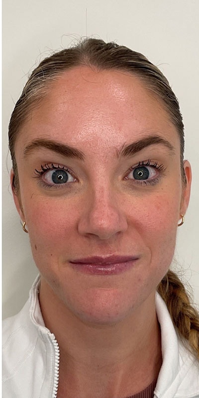 Botox Before & After Image