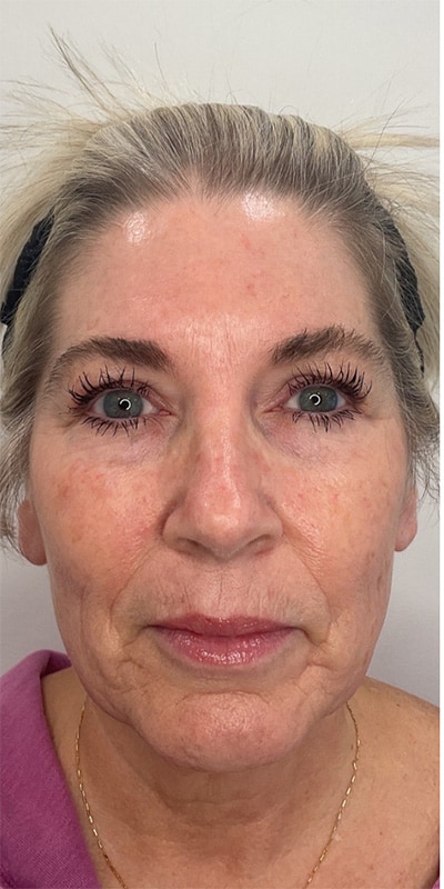 Botox Before & After Image