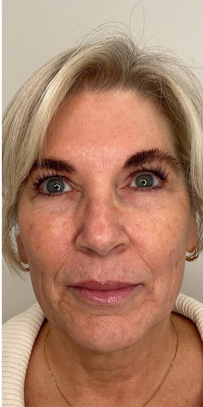 Botox Before & After Image