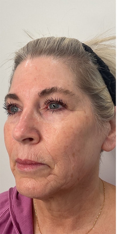 Botox Before & After Image