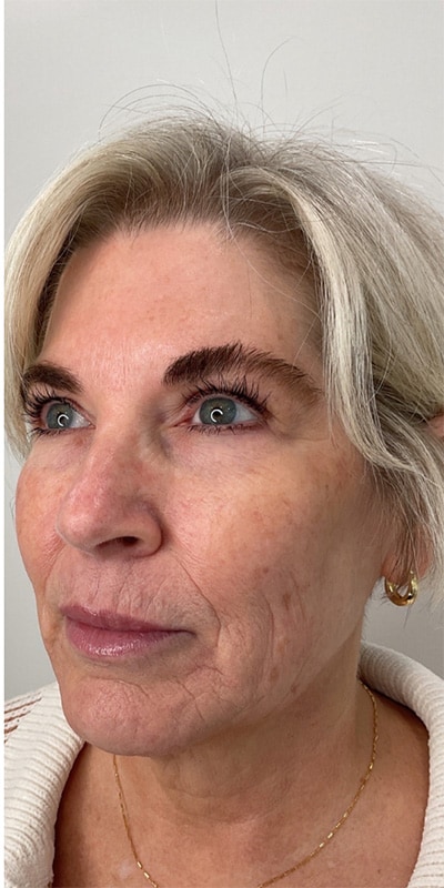 Botox Before & After Image