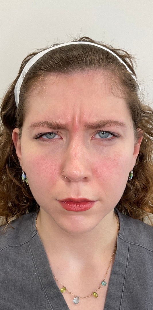 Botox Before & After Image