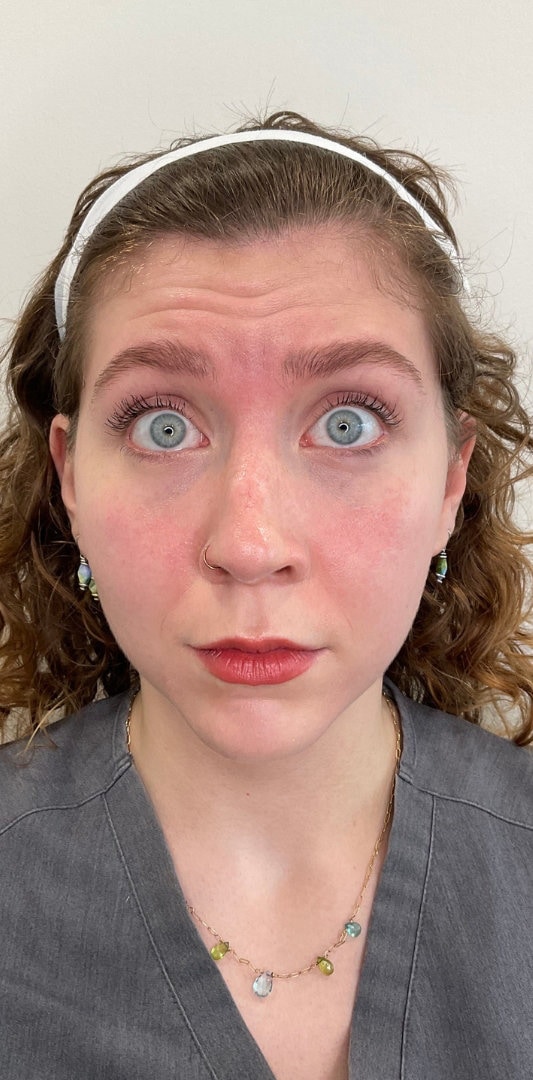 Botox Before & After Image