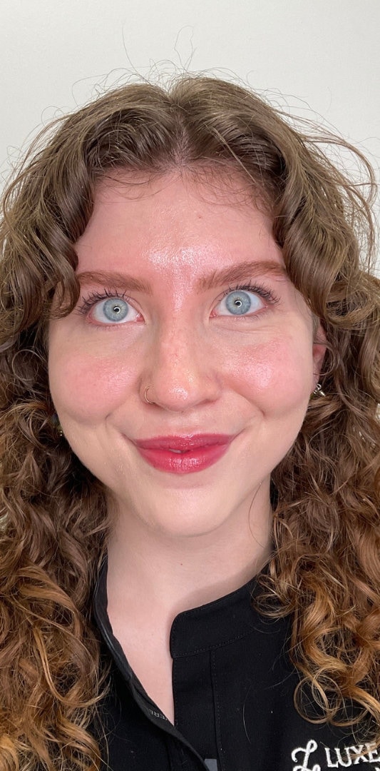 Botox Before & After Image