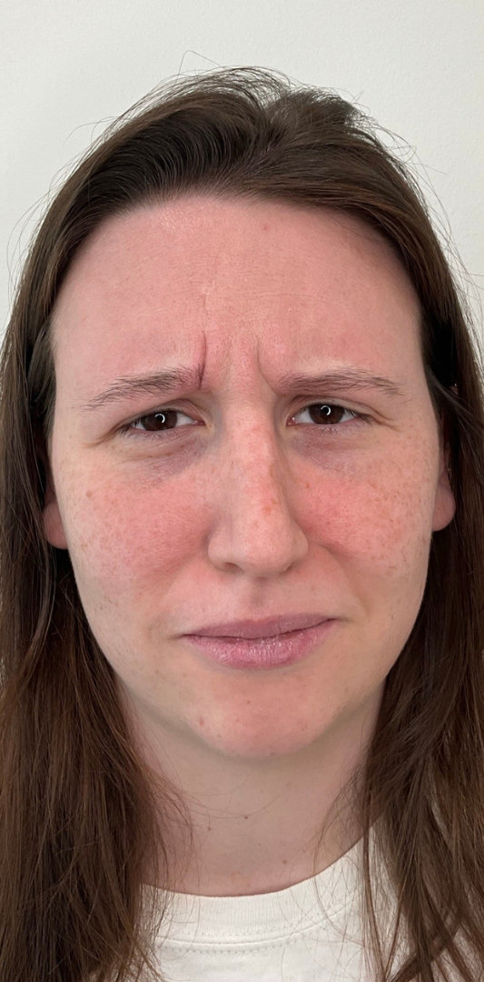 Botox Before & After Image