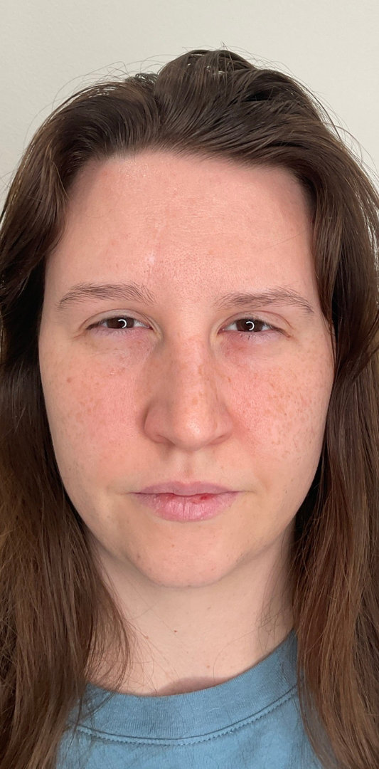 Botox Before & After Image