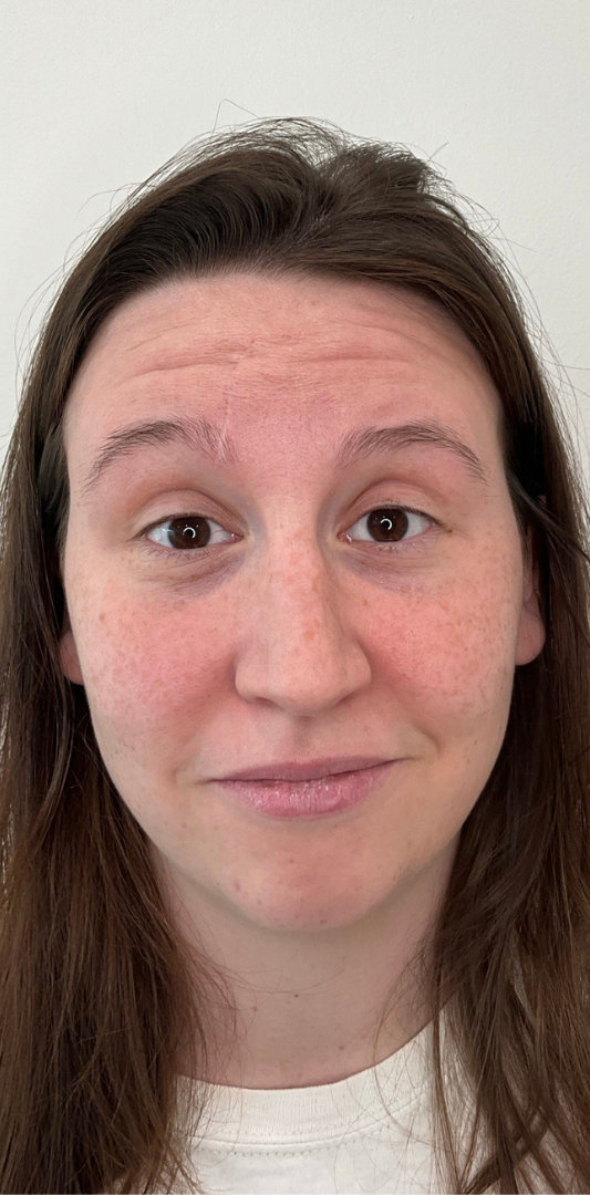 Botox Before & After Image
