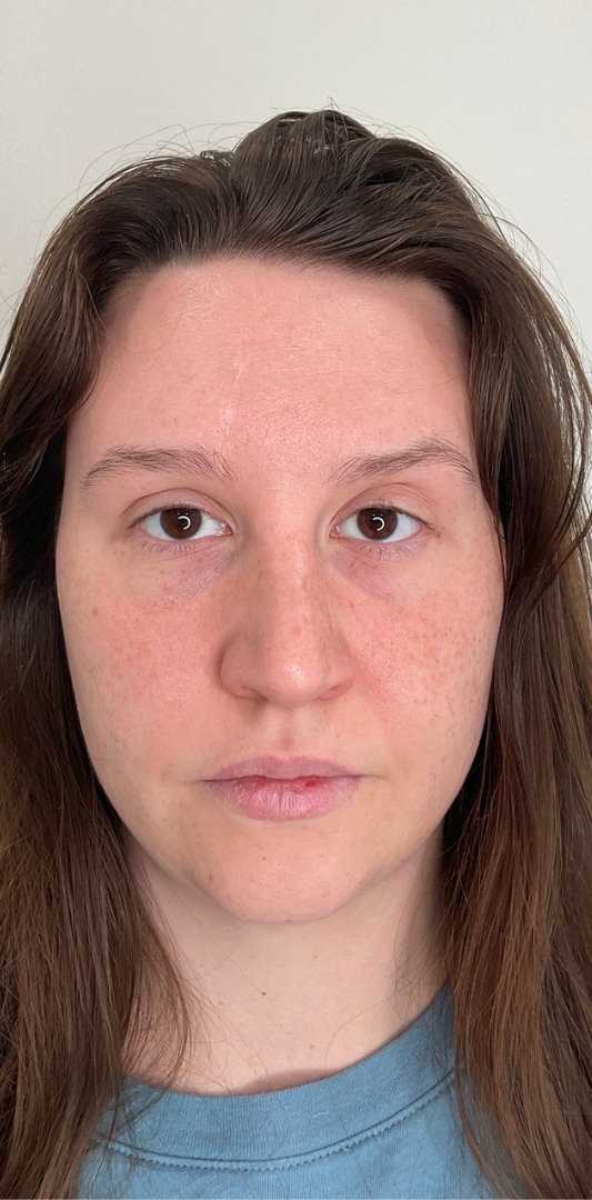 Botox Before & After Image
