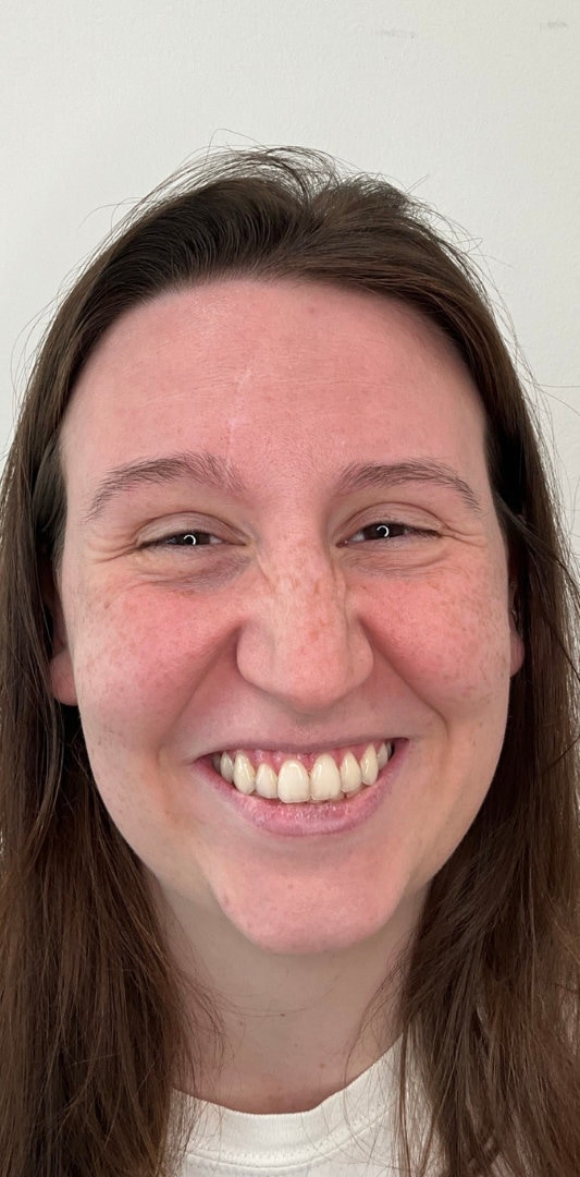 Botox Before & After Image