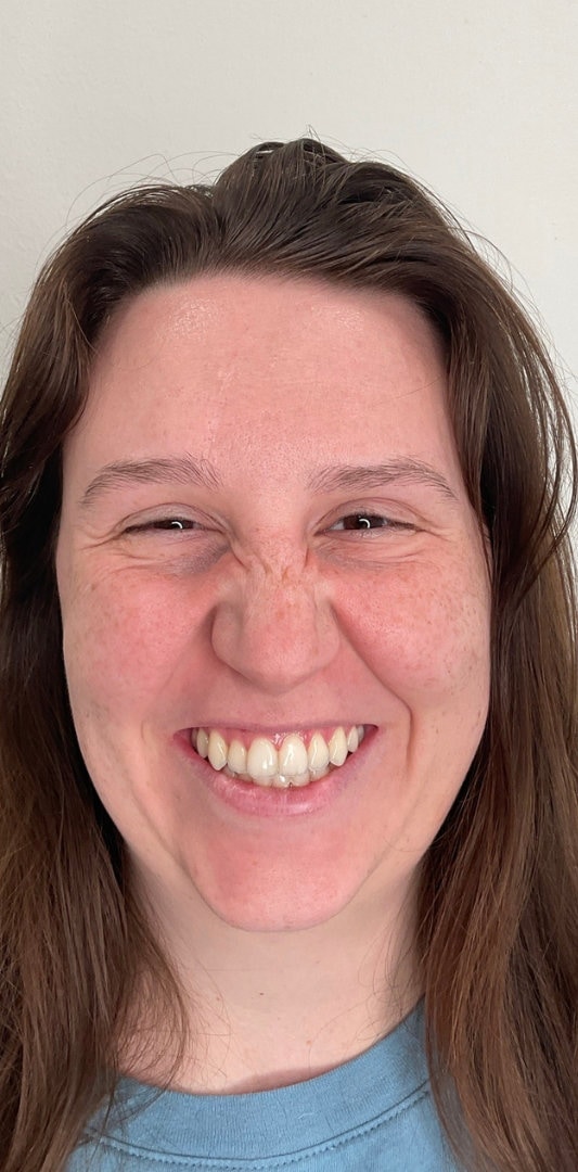 Botox Before & After Image