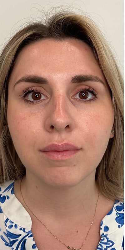 Cheek Fillers Before & After Image