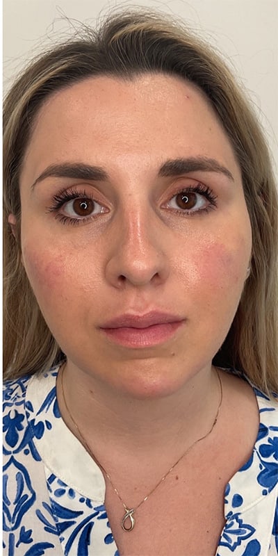 Cheek Fillers Before & After Image