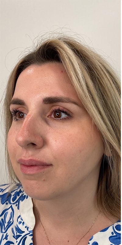 Cheek Fillers Before & After Image