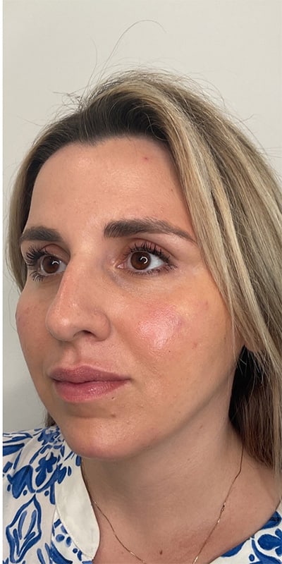 Cheek Fillers Before & After Image