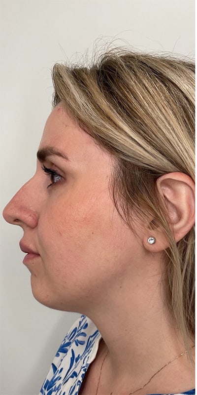 Cheek Fillers Before & After Image