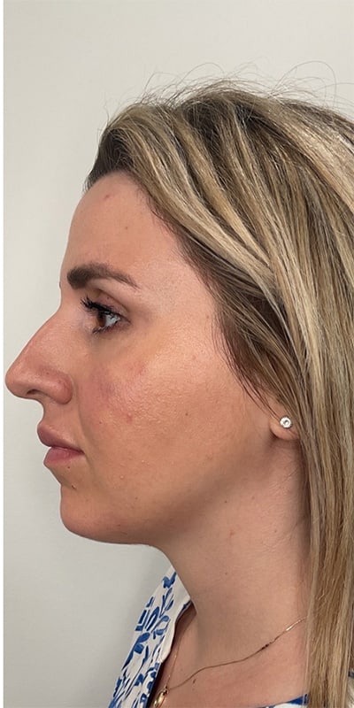 Cheek Fillers Before & After Image