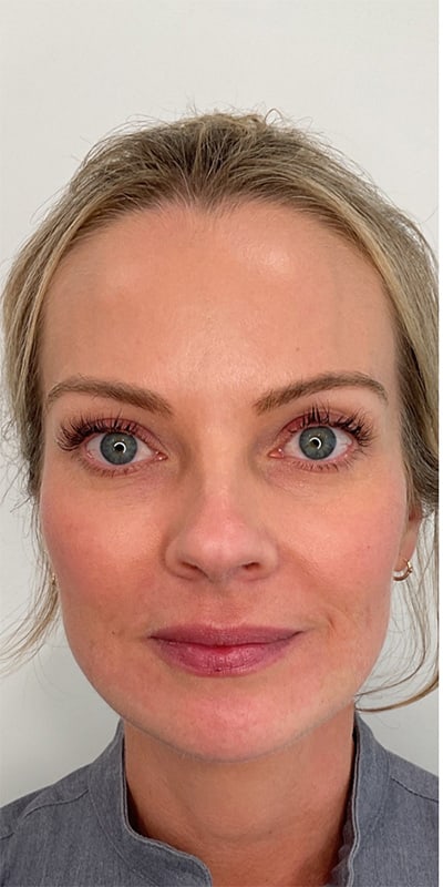 Chin Fillers Before & After Image