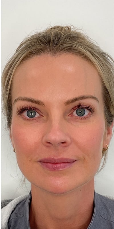 Chin Fillers Before & After Image