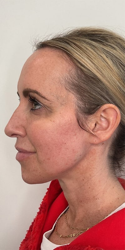 Chin Fillers Before & After Image