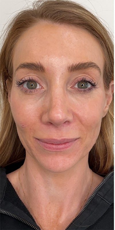 Chin Fillers Before & After Image