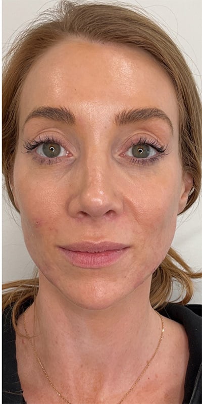 Chin Fillers Before & After Image