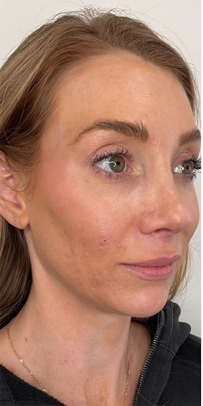 Chin Fillers Before & After Image