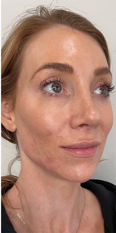 Chin Fillers Before & After Image