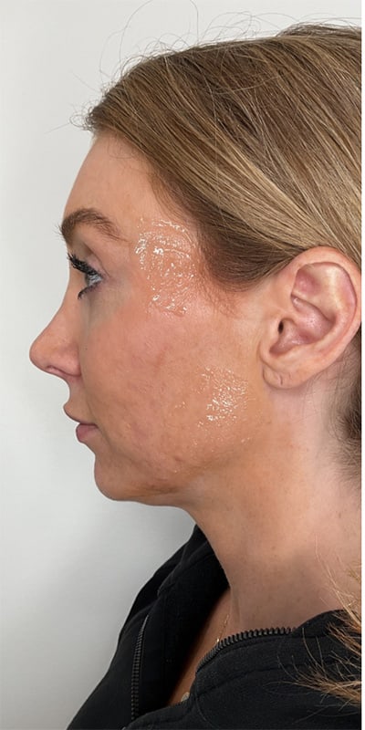 Chin Fillers Before & After Image