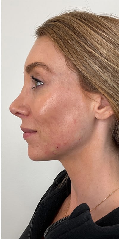 Chin Fillers Before & After Image