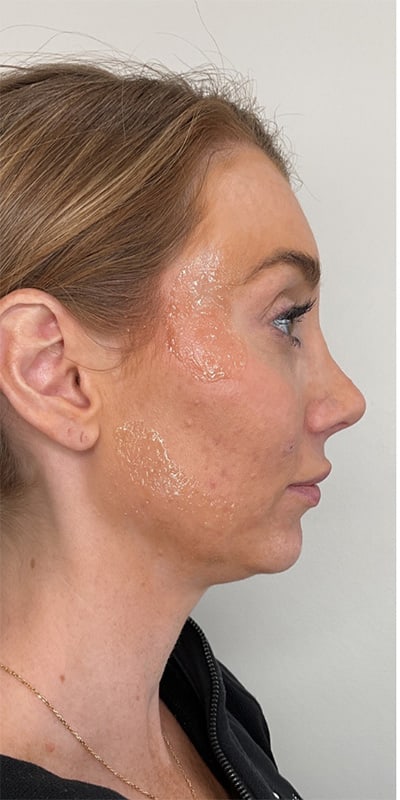 Chin Fillers Before & After Image