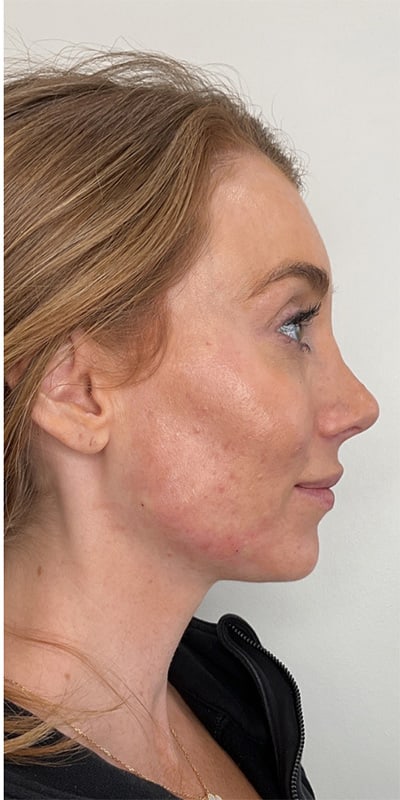 Chin Fillers Before & After Image