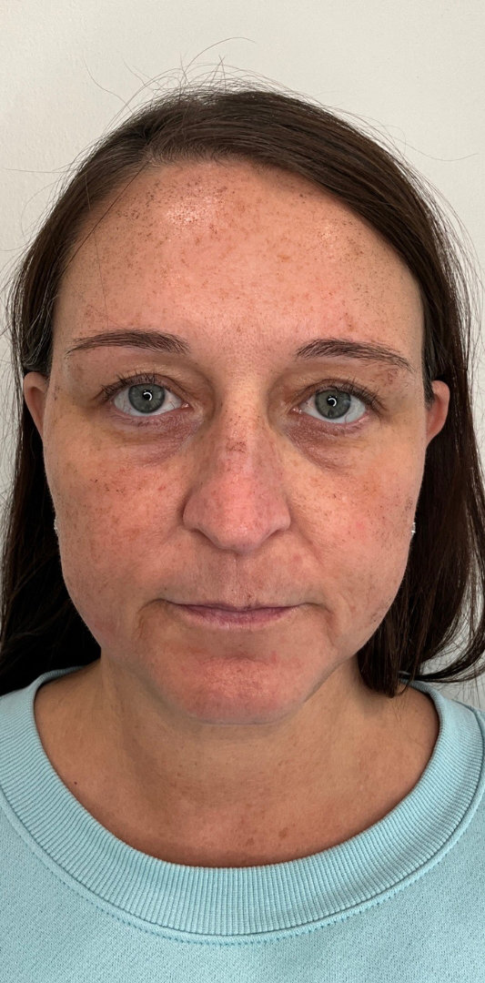 Chin Fillers Before & After Image