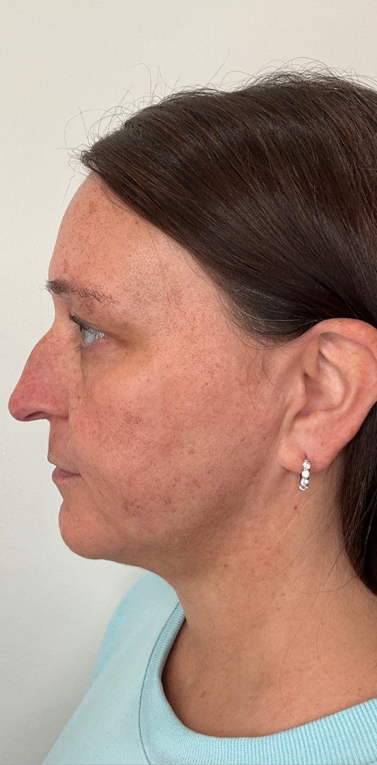 Chin Fillers Before & After Image