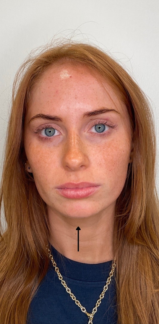 Chin Fillers Before & After Image