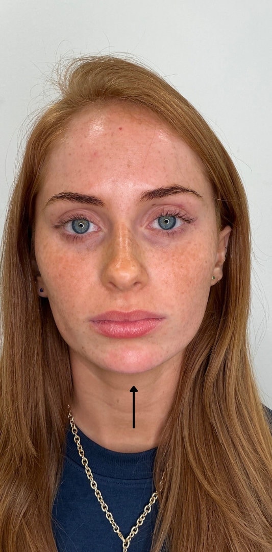 Chin Fillers Before & After Image