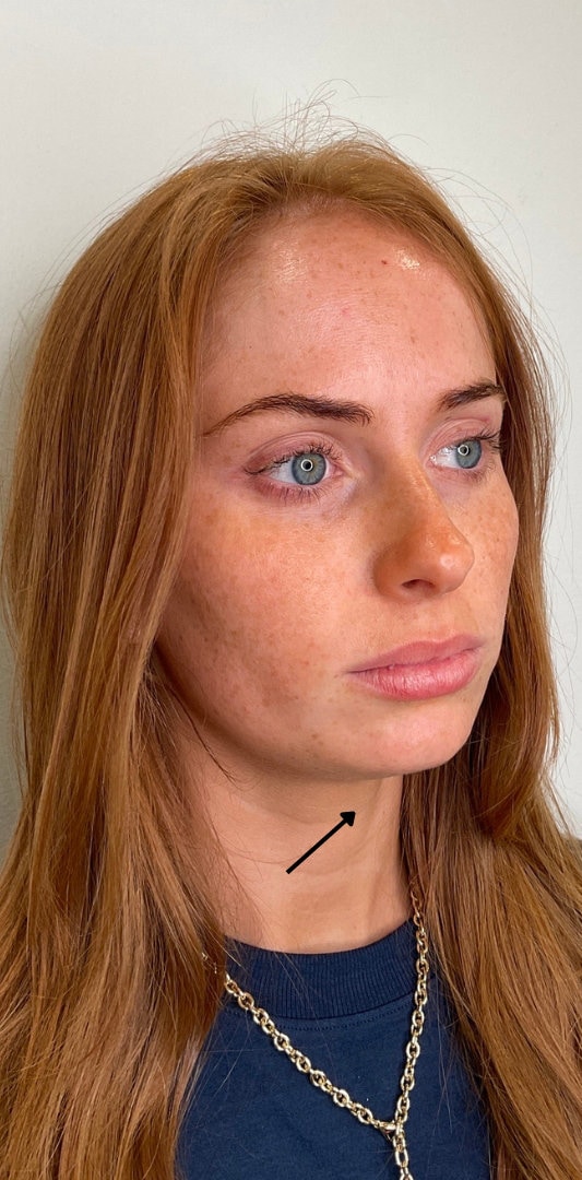 Chin Fillers Before & After Image