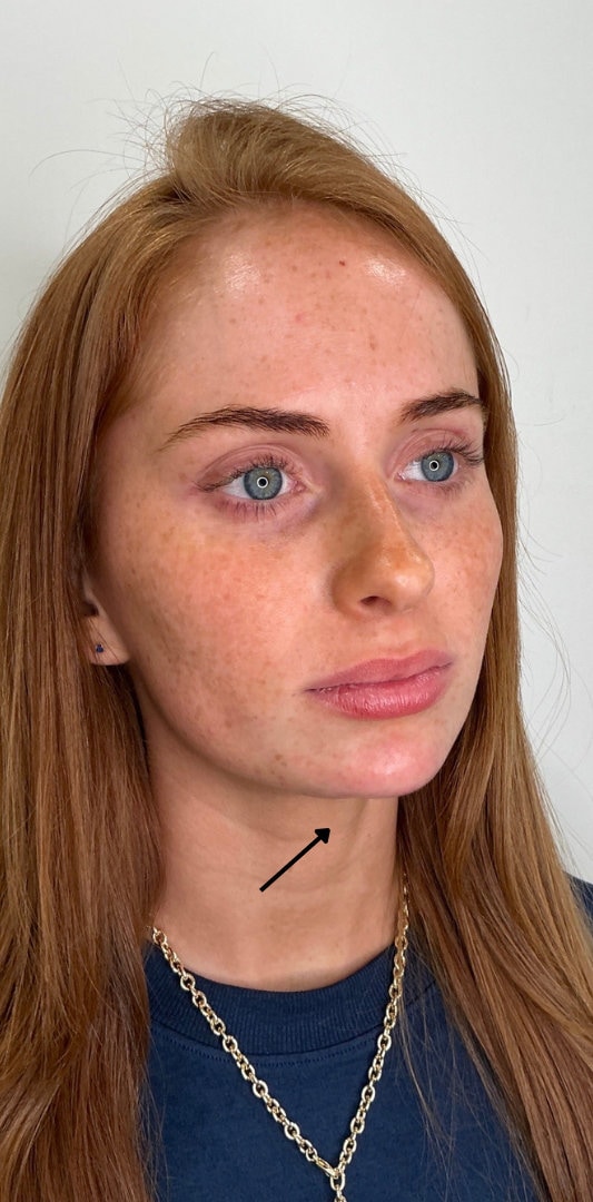 Chin Fillers Before & After Image