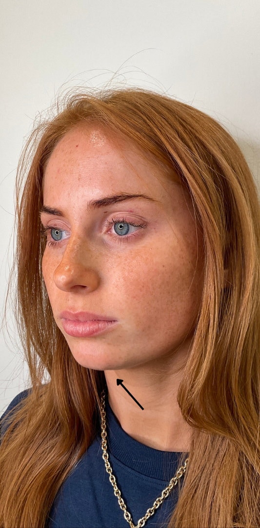 Chin Fillers Before & After Image